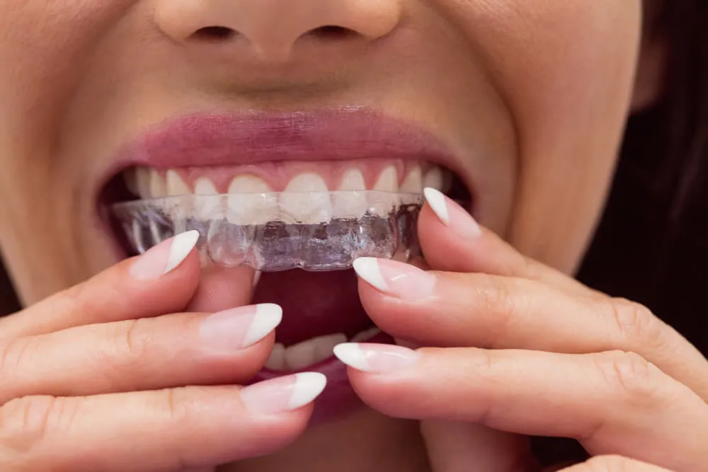 limpiar invisalign
